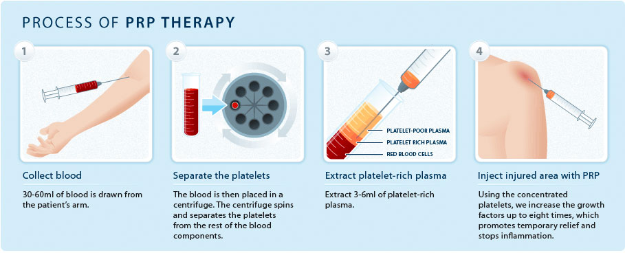 The process of PRP therapy